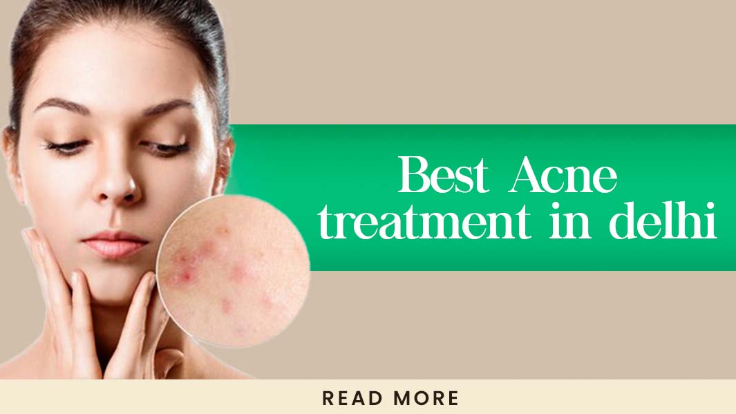 Acne Treatment Solutions in Delh