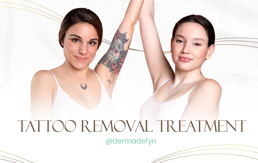 Tattoo Removal Treatment